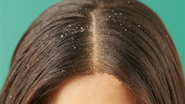 الحنجرة عيار المؤمن  علاج قشرة شعر الرأس نهائيا من أول مرة