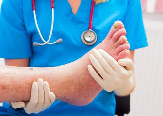 تغير لون وملمس الجلد 4 أعراض تدل على إصابة الرجل بـ انسداد الشرايين