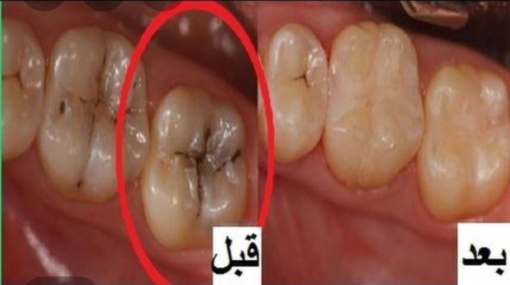 تحمي من الأمراض 8 فوائد لتنظيف الأسنان وأشهر الطرق لعلاجها