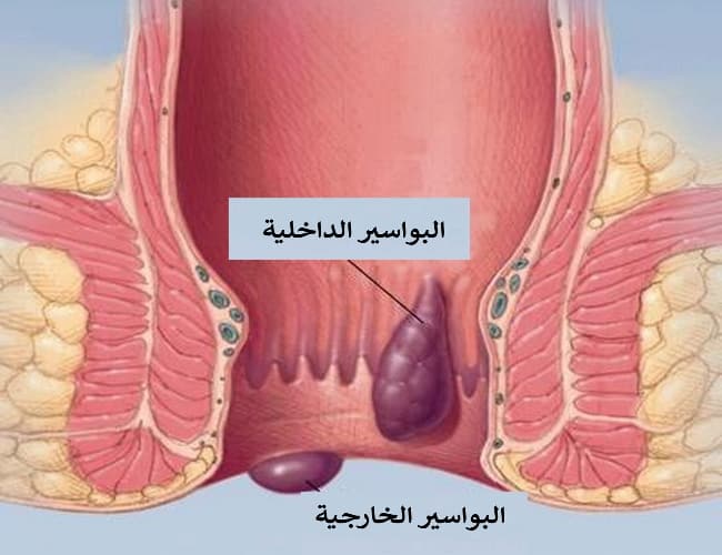 بالثلج والأعشاب.. علاج البواسير الداخلية في المنزل